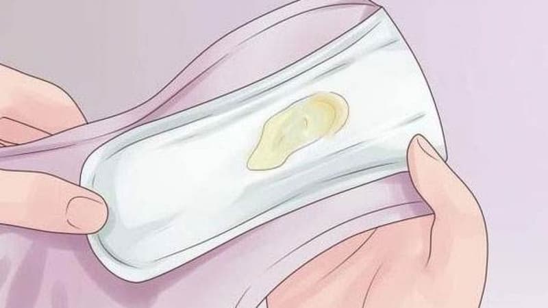 Khí hư màu vàng là biểu hiện của nhiều căn bệnh phụ khoa nguy hiểm