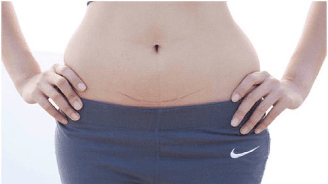 Sinh mổ thẩm mỹ