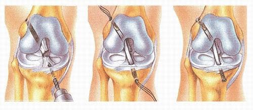 Hiện nay, mổ nội soi tái tạo dây chằng khớp gối bằng một mảnh gân khác thay thế là phương pháp phẫu thuật hiệu quả