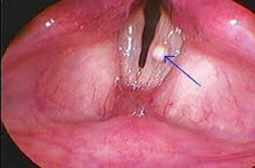 Khi tìm hiểu mổ hạt xơ dây thanh có nguy hiểm không, cần khẳng định đậy là phẫu thuật khá an toàn