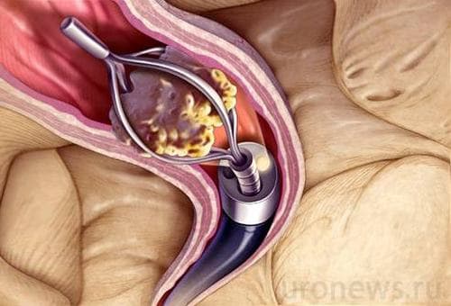 Chất oxalate là một trong những nguyên nhân chính gây nên bệnh sỏi thận.