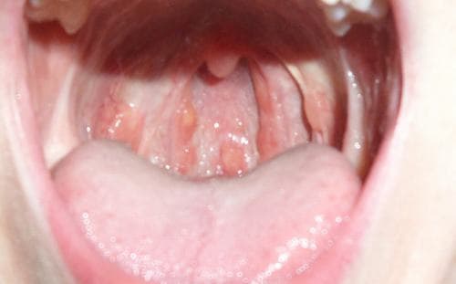 Nội soi cổ họng giúp khắc phục những hạn chế của kiểu khám cũ trước đây. 