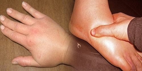 Khi bị viêm cầu thận cấp, người bệnh thường bị sưng húp, phù nề ở mặt, có trường hợp cả chân tay cũng sưng phù.