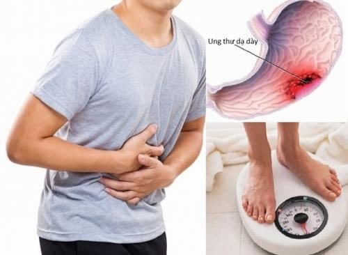 Ung thư dạ dày di căn gan là giai đoạn cuối của bệnh khi mà các tế bào ung thư đã phát triển ra ngoài dạ dày,