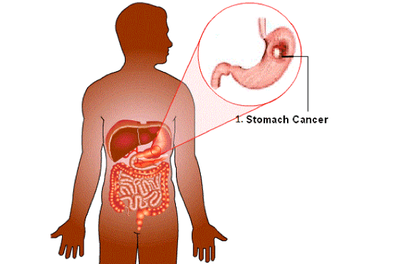 Ung dạ dày di căn phổi có chữa khỏi không? Thời gian sống bao lâu?