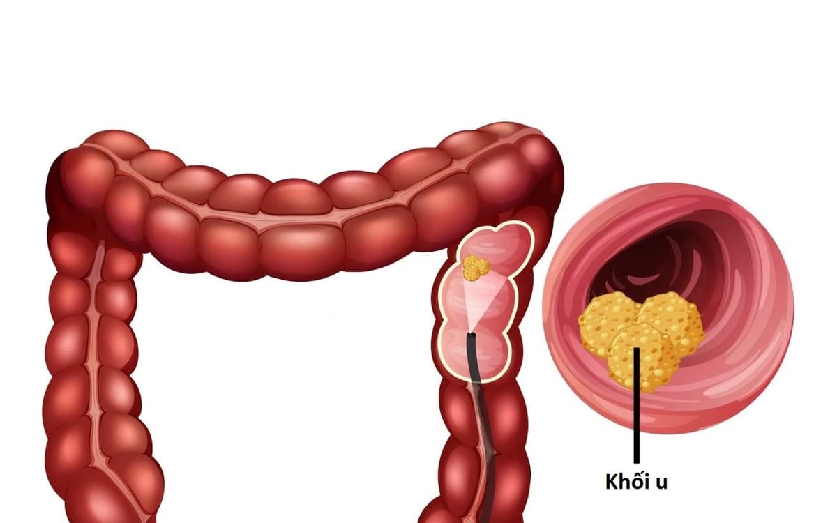 Ung thư đại tràng giai đoạn III: Biểu hiện và điều trị