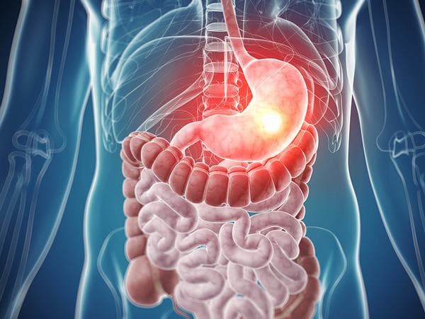 &#8220;Vạch trần&#8221; bộ 3 ung thư dạ dày &#8211; thực quản &#8211; đại trực tràng chỉ một lần khám