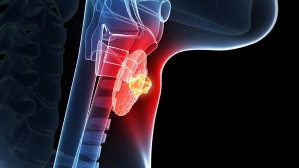 Ung thư tuyến giáp là khối u hình thành ở vùng tuyến giáp, sau đó các tế bào ung thư phát triển và di căn tạo hạch ở vùng cổ.