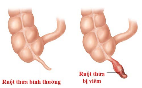 Viêm ruột thừa đặc trưng bởi hiện tượng tắc và viêm của ruột thừa (cơ quan nhỏ nối thông với phần đầu của ruột già).