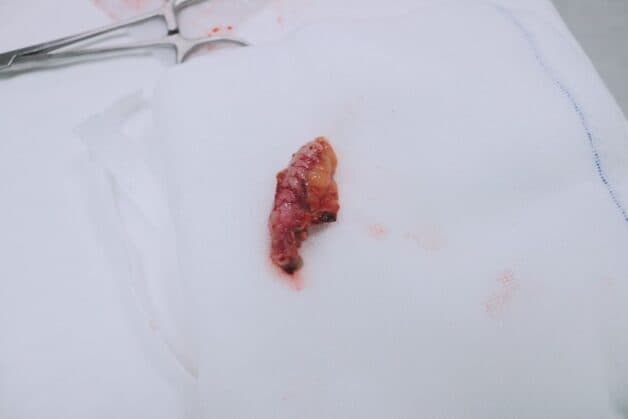 Phẫu thuật là phương pháp hữu hiệu nhất trong điều trị viêm ruột thừa.