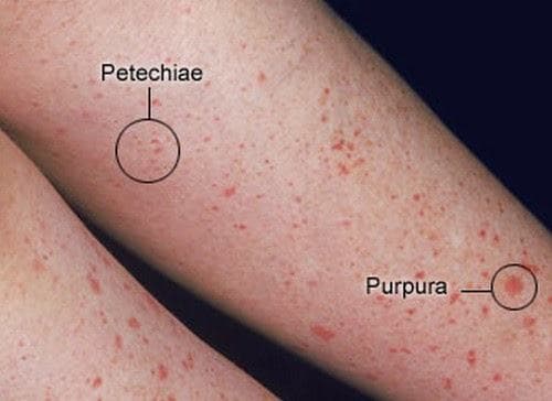 Bệnh thiếu tiểu cầu hay giảm tiểu cầu là một trong các bệnh lý về máu khá phổ biến.