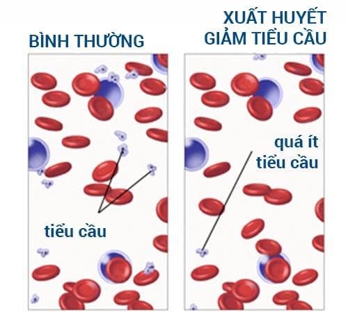 Bệnh thiếu tiểu cầu có nghiêm trọng không ?