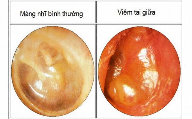 Bệnh viêm tai giữa cấp ở người lớn là gì?