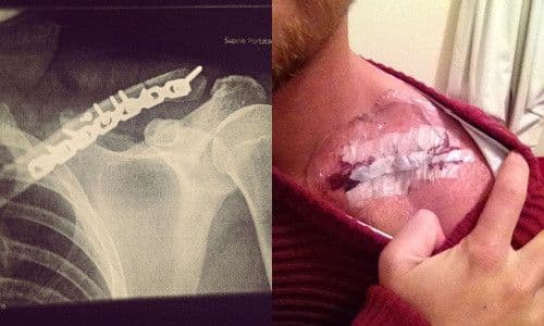 biến chứng sau mổ gãy xương đòn