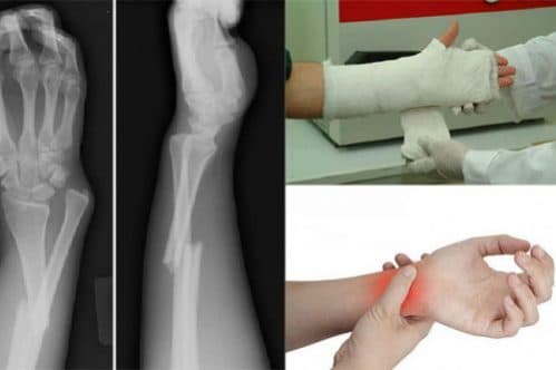 Cách làm xương bị gãy nhanh lành 
