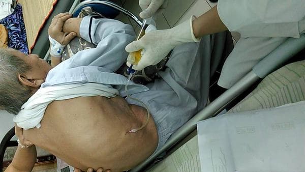 Chọc hút dịch màng phổi thường được chỉ định để điều trị tràn dịch màng phổi