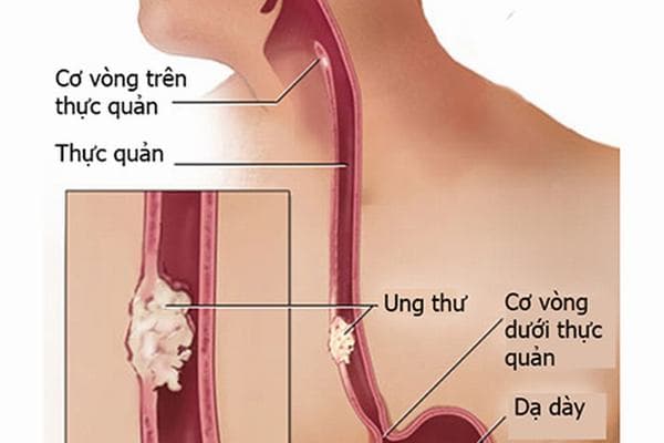Ung thư thực quản di căn là giai đoạn cuối của bệnh.