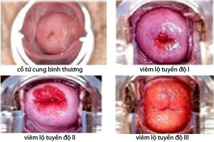 Các mức độ tiến triển của viêm lộ tuyến cổ tử cung.