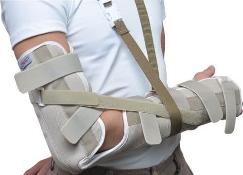 Cách xử lý, điều trị khi bị gãy xương cánh tay