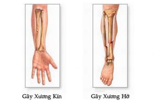 Biểu hiện của gãy xương