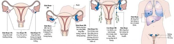 Ung thư buồng trứng di căn sống được bao lâu?
