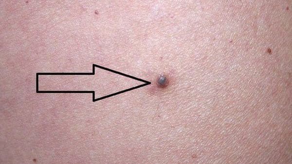 Hình ảnh ung thư da – TCI Hospital