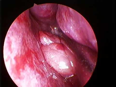 Hình ảnh nội soi cổ họng