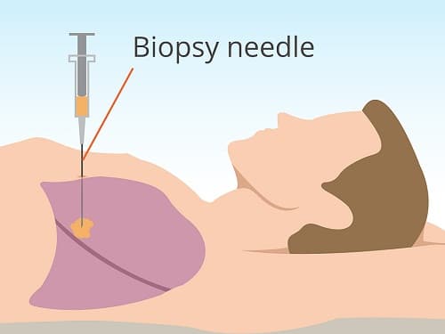 choc sinh thiet phoi