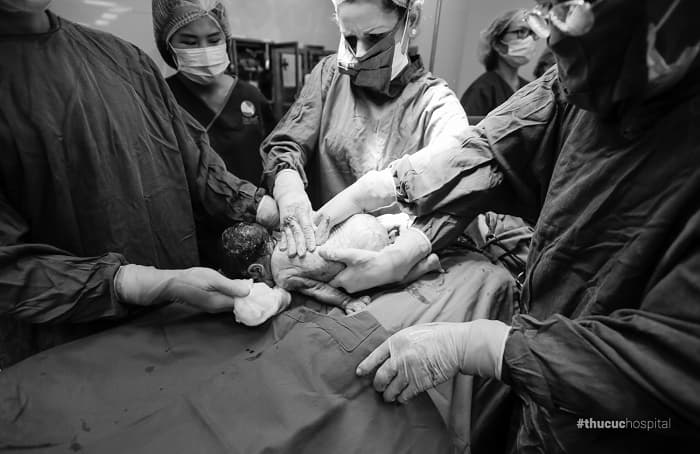 Em bé khi sinh mổ có nguy cơ gặp các vấn đề về hô hấp.