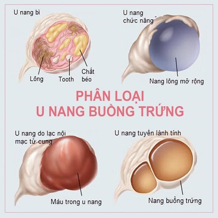 Mỗi loại u nang buồng trứng có đặc điểm và mức độ nguy hiểm khác nhau, từ nang cơ năng lành tính đến khối u cần theo dõi sát