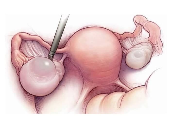 U nang buồng trứng ác tính: Triệu chứng và cách phòng ngừa