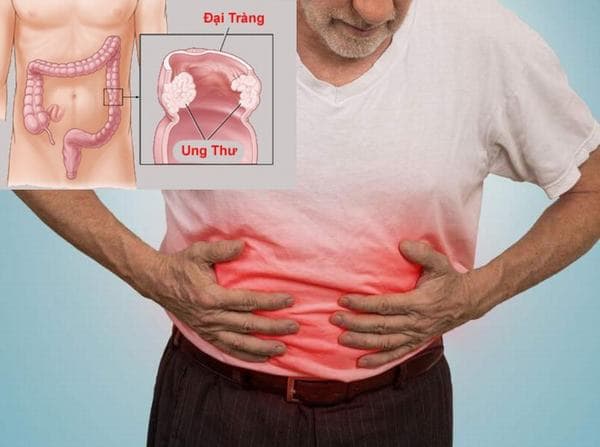 Người bệnh ung thư đại tràng di căn sẽ gây ảnh hưởng nghiêm trọng tới sức khỏe