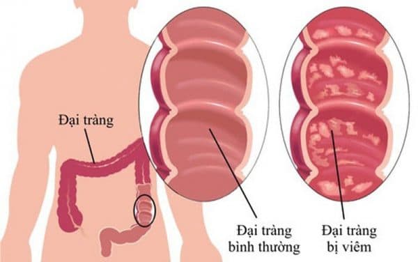 viem dai trang hay tai phat