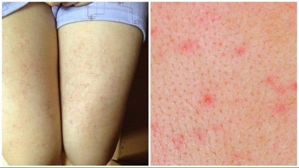 Biểu hiện của viêm lỗ chân lông