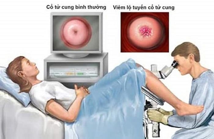 Để điều trị viêm lộ tuyến cổ tử cung cấp độ 3, bác sĩ sẽ phối hợp nhiều phương pháp như dùng thuốc kháng sinh, đốt điện hoặc laser, áp lạnh...