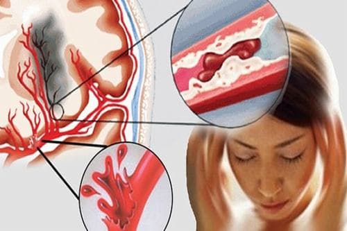 Rất nhiều người muốn tìm hiểu xuất huyết não có chữa được không.