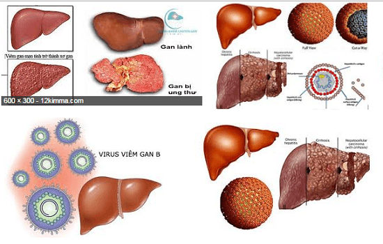 Việt Nam đứng thứ 3 thế giới về tỷ lệ mắc ung thư gan