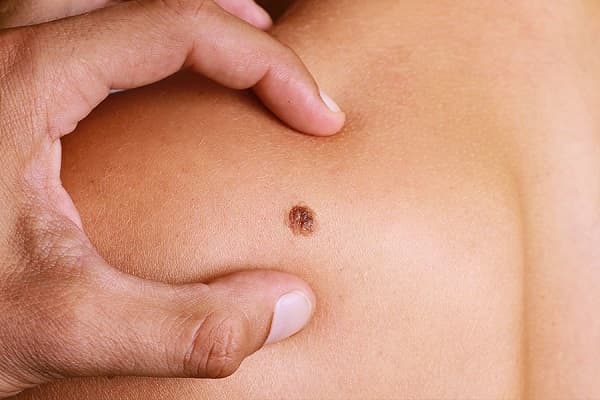 Điều trị ung thư da ở viện nào?