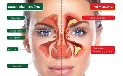 Viêm mũi xoang là bệnh lý rất phổ biến có thể gặp ở bất kì đối tượng nào