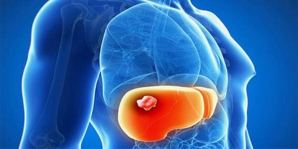 Ung thư gan cũng có thể phát hiện nhờ dấu ấn ung thư AFP