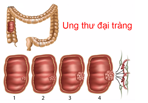 Ung thư đại tràng di căn là giai đoạn cuối của bệnh