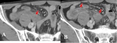 hinh-anh-ct-viem-ruot-thua-4