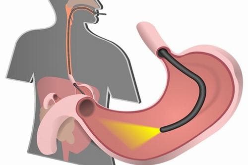 Nội soi qua đường miệng kiểu truyền thống với những hạn chế lớn đã được khắc phục nhờ nội soi dạ dày không đau hiện nay.