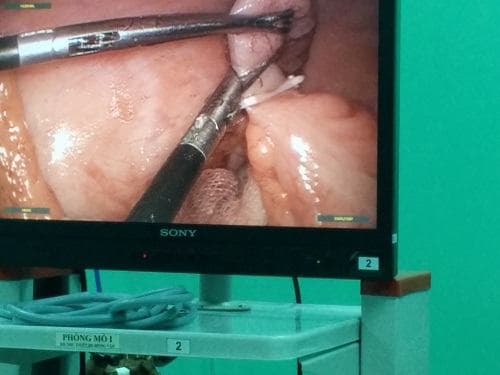 Mổ nội soi là giải pháp cho những trường hợp lo lắng với vấn đề sau mổ ruột thừa có đau không.