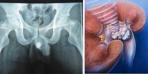 Sỏi niệu đạo thường gặp ở nam giới nhiều hơn nữ giới. 