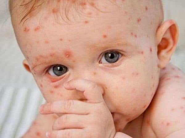 Bệnh sởi – rubella là một trong những bệnh truyền nhiễm nguy hiểm