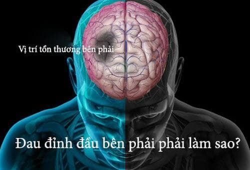 Đau ở đỉnh đầu là triệu chứng từng gặp phải ở không ít người