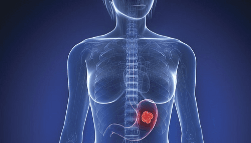 Ung thư dạ dày đang có xu hướng gia tăng và trẻ hóa