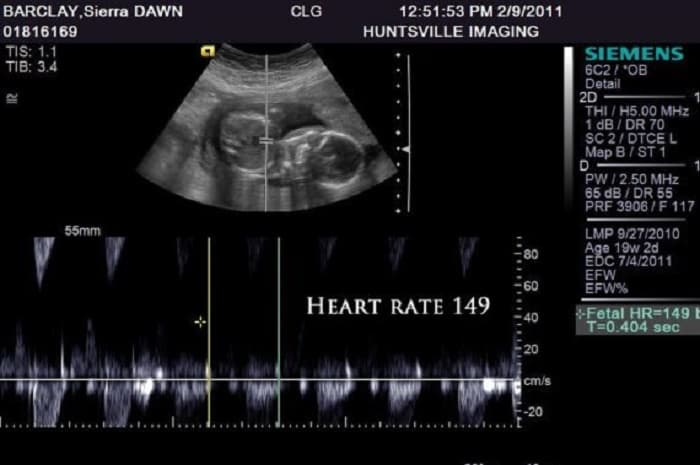 Tim thai 160 lần mỗi phút là trai hay gái