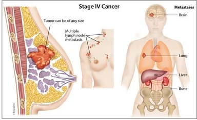 Là nữ giới, không nên bỏ qua tầm soát ung thư vú &#8211; phụ khoa